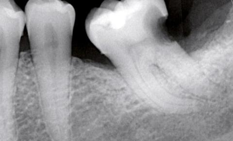 biocéramiques : dentiste à franconville 
